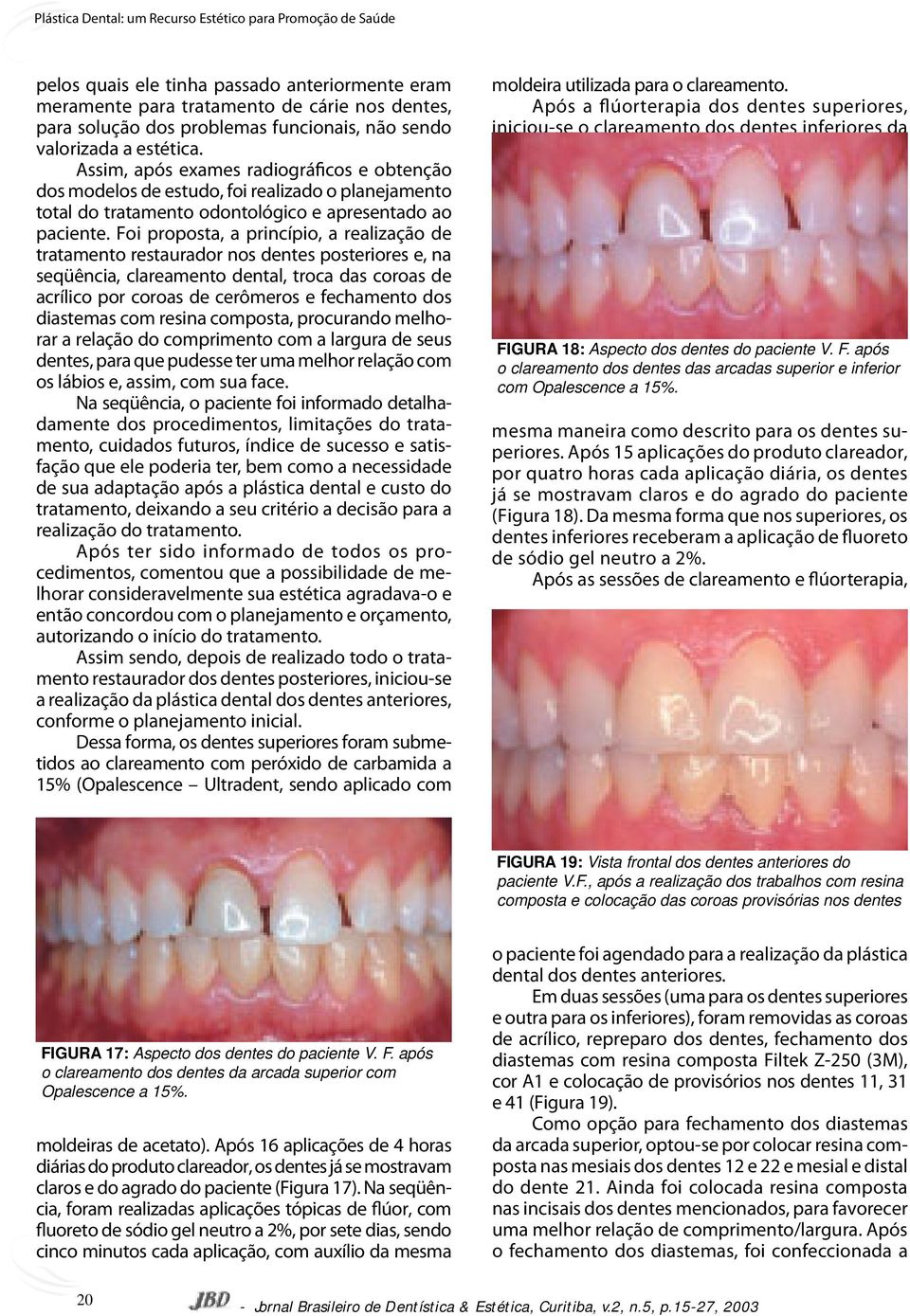 Foi proposta, a princípio, a realização de tratamento restaurador nos dentes posteriores e, na seqüência, clareamento dental, troca das coroas de acrílico por coroas de cerômeros e fechamento dos