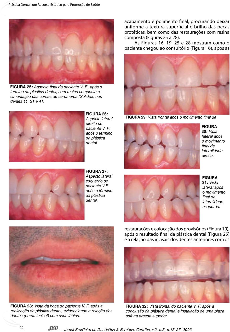 FIGURA 26: Aspecto lateral direito do paciente V. F. após o término da plástica dental.