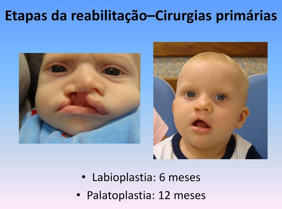 Cirurgias primárias