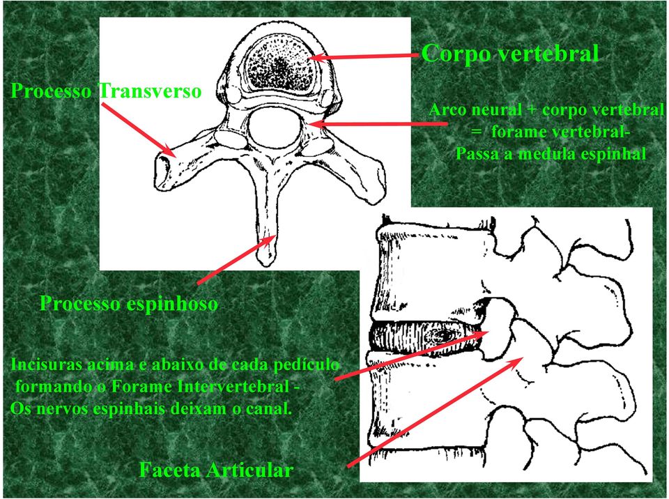 espinhoso Incisuras acima e abaixo de cada pedículo formando o