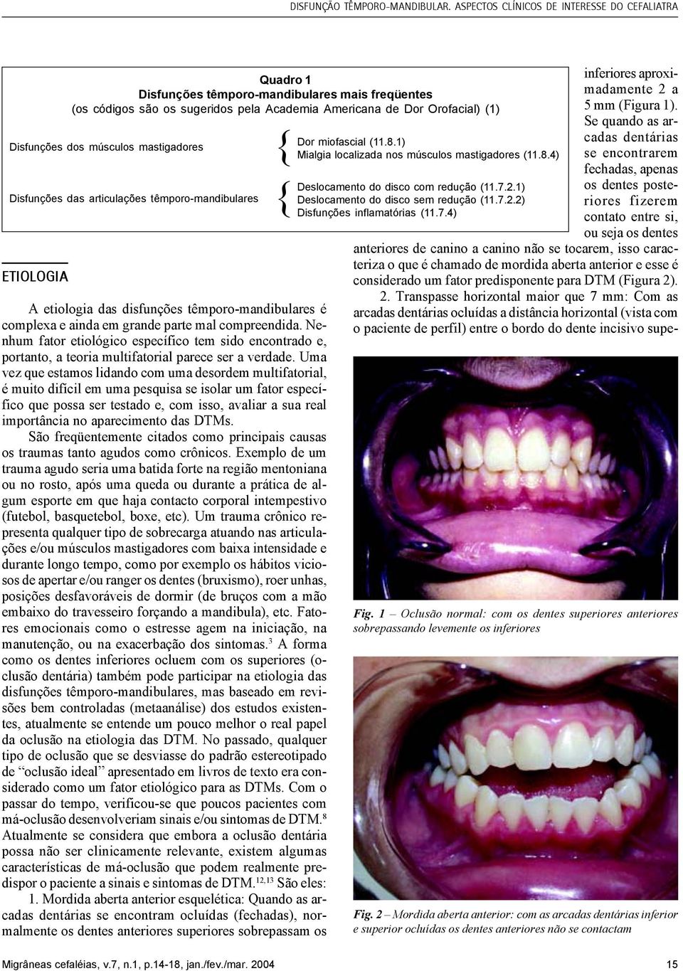 dos músculos mastigadores Disfunções das articulações têmporo-mandibulares A etiologia das disfunções têmporo-mandibulares é complexa e ainda em grande parte mal compreendida.