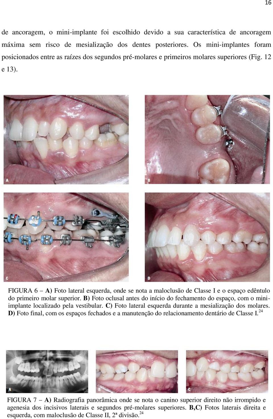 FIGURA 6 A) Foto lateral esquerda, onde se nota a maloclusão de Classe I e o espaço edêntulo do primeiro molar superior.