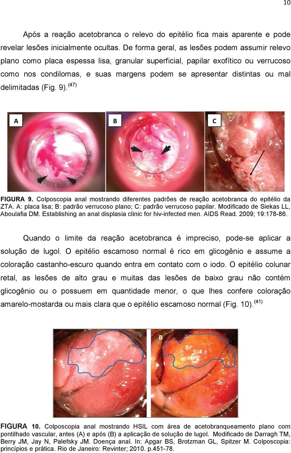 mal delimitadas (Fig. 9). (47) A B C FIGURA 9. Colposcopia anal mostrando diferentes padrões de reação acetobranca do epitélio da ZTA.