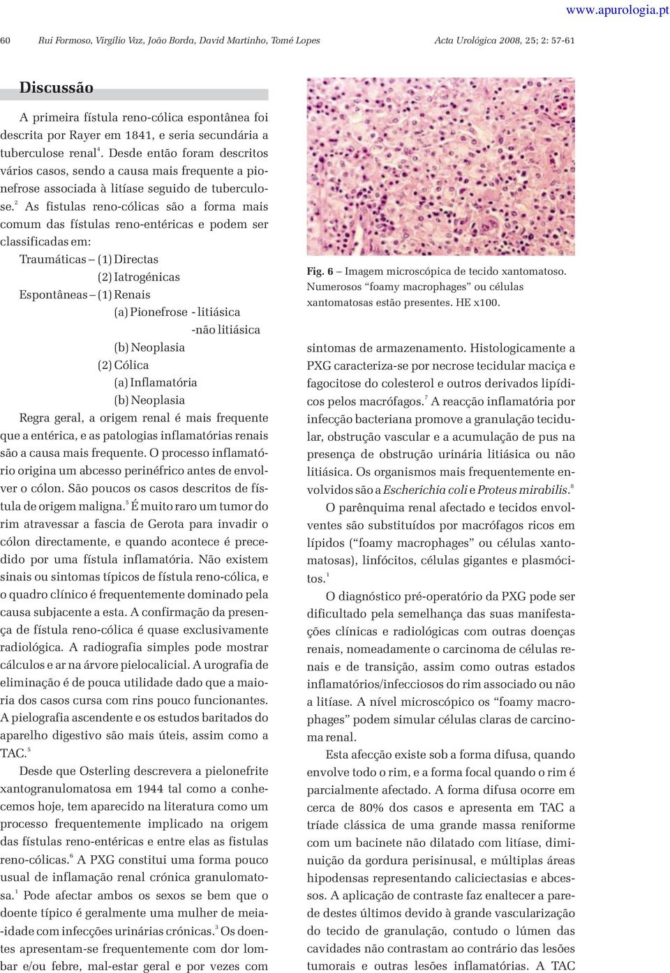 As fistulas reno-cólicas são a forma mais comum das fístulas reno-entéricas e podem ser classificadas em: Traumáticas () Directas () Iatrogénicas Espontâneas () Renais (a) Pionefrose - litiásica -não