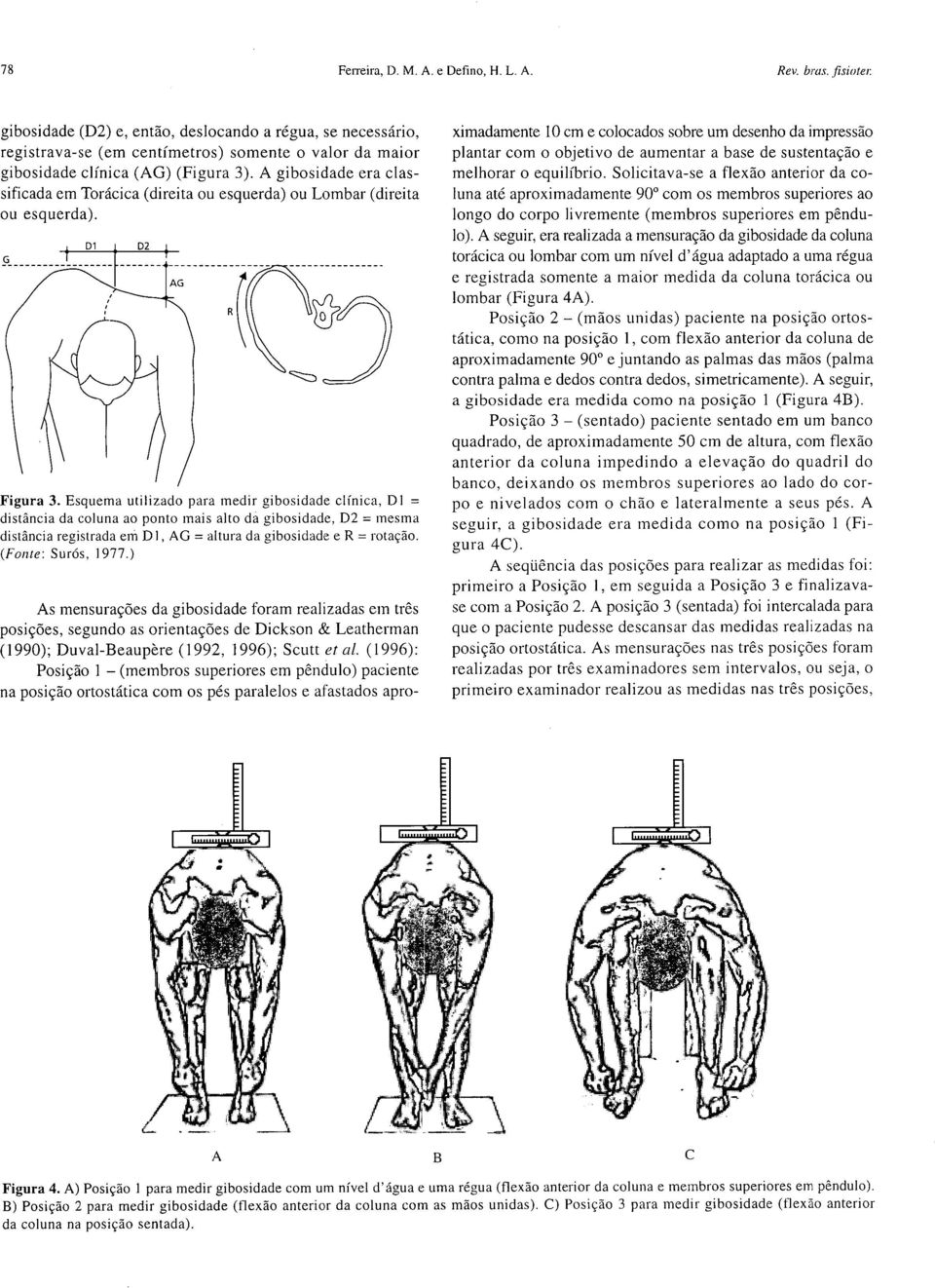 A gibosidade era classificada em Torácica (direita ou esquerda) ou Lombar (direita ou esquerda). Figura 3.