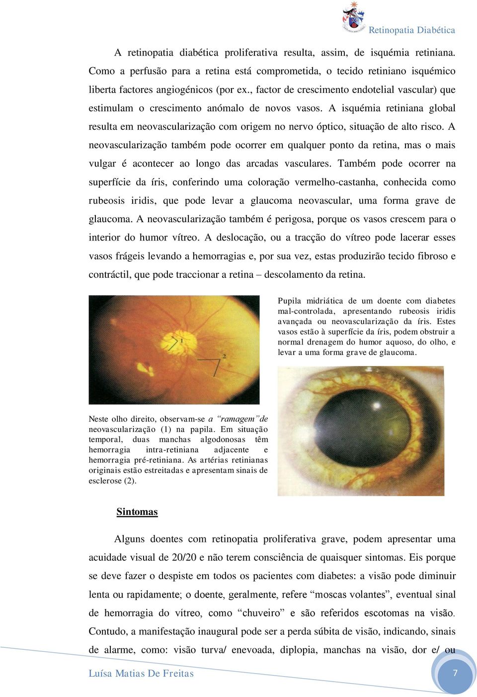 A isquémia retiniana global resulta em neovascularização com origem no nervo óptico, situação de alto risco.