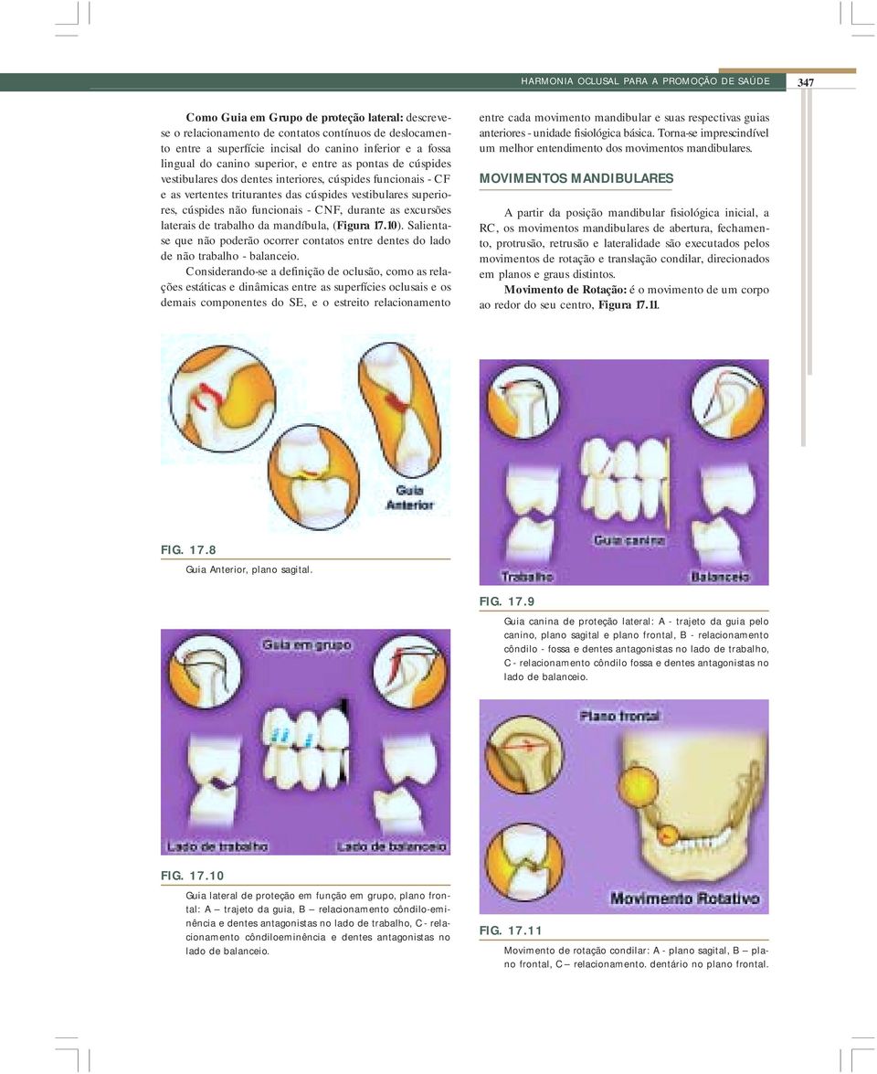 cúspides não funcionais - CNF, durante as excursões laterais de trabalho da mandíbula, (Figura 17.10). Salientase que não poderão ocorrer contatos entre dentes do lado de não trabalho - balanceio.