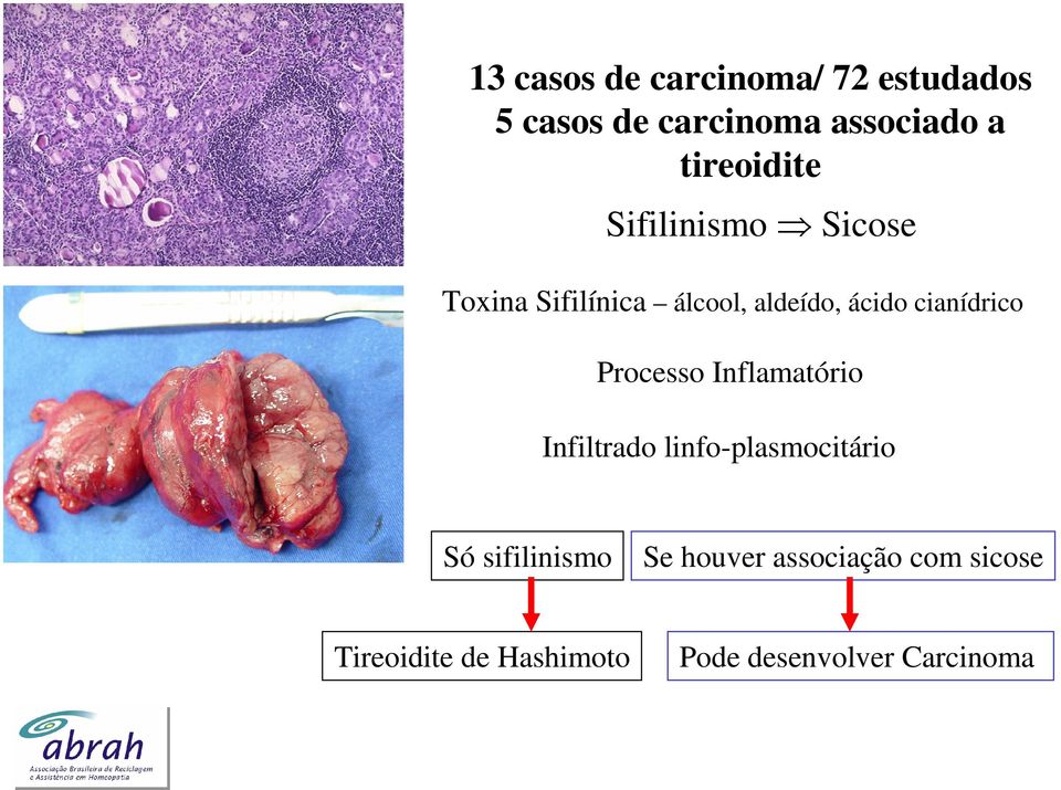 cianídrico Processo Inflamatório Infiltrado linfo-plasmocitário Só