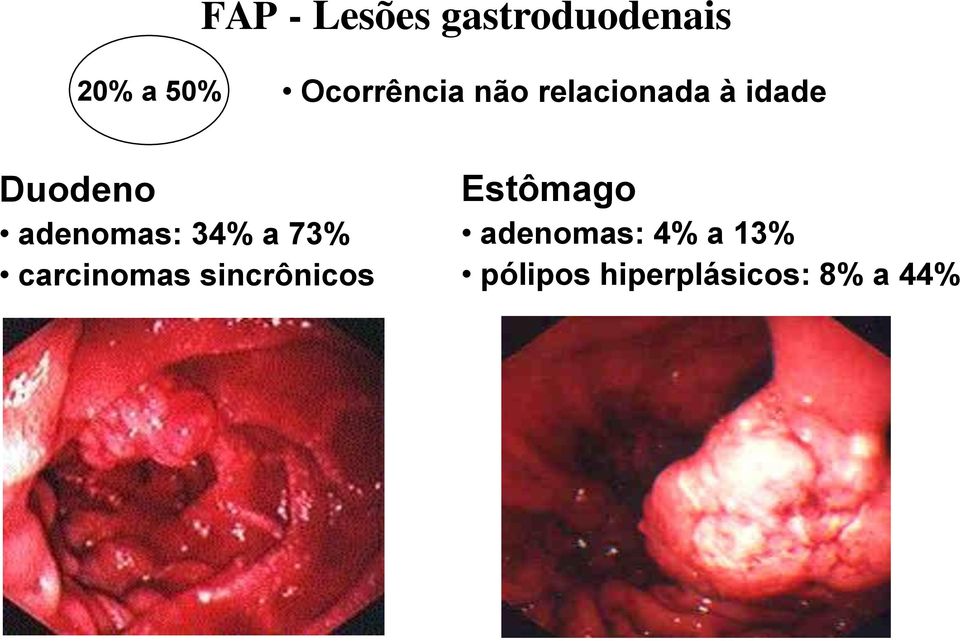 adenomas: 34% a 73% carcinomas sincrônicos