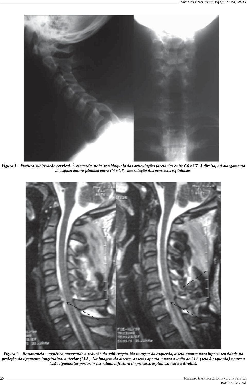 Figura 2 Ressonância magnética mostrando a redução da subluxação.