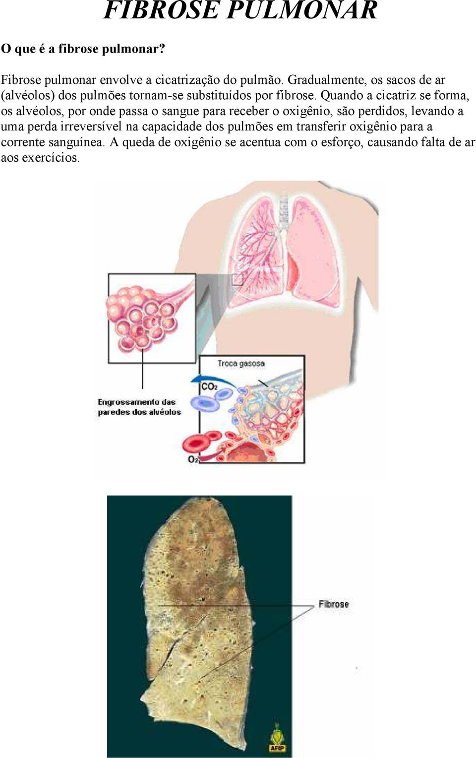 Quando a cicatriz se forma, os alvéolos, por onde passa o sangue para receber o oxigênio, são perdidos, levando a uma