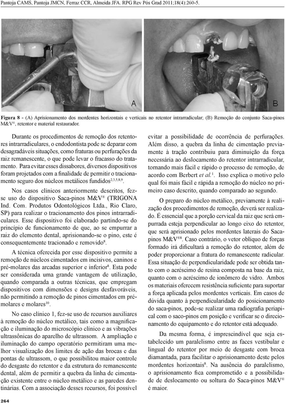 fracasso do tratamento. Para evitar esses dissabores, diversos dispositivos foram projetados com a finalidade de permitir o tracionamento seguro dos núcleos metálicos fundidos 2,3,5,8,9.