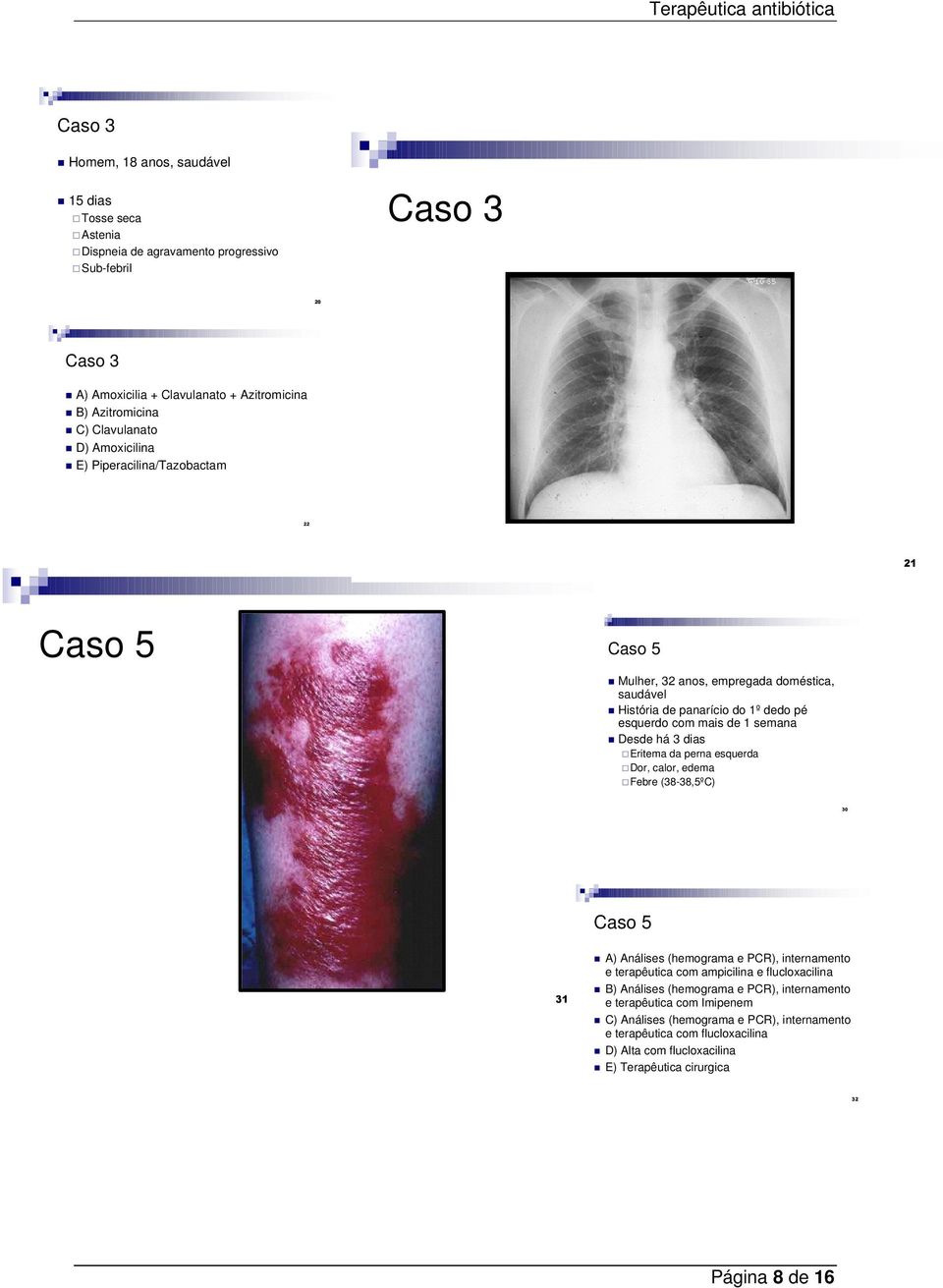 há 3 dias Eritema da perna esquerda Dor, calor, edema Febre (38-38,5ºC) 30 Caso 5 31 A) Análises (hemograma e PCR), internamento e terapêutica com ampicilina e flucloxacilina B) Análises