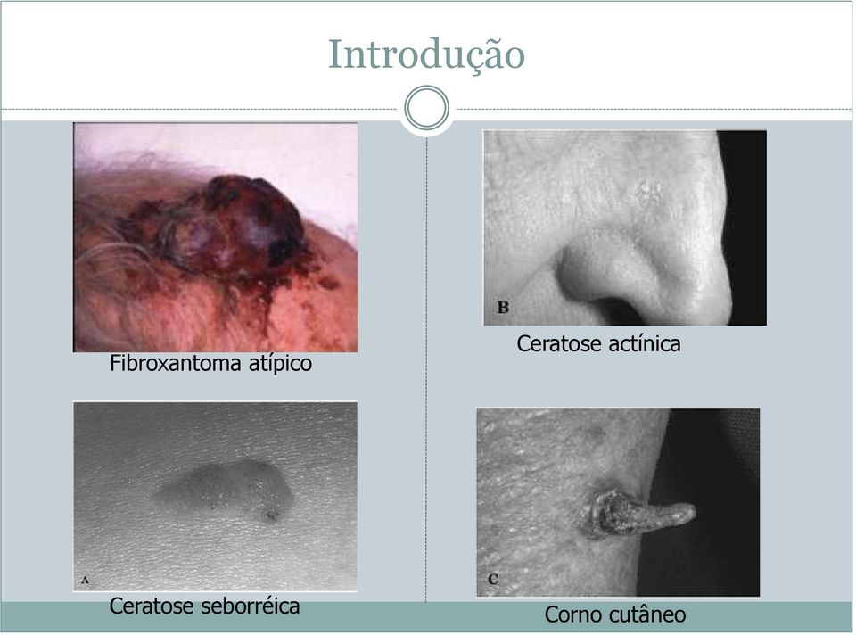 Ceratose actínica