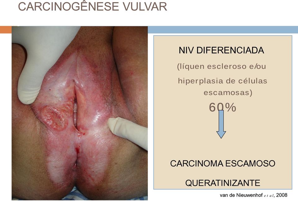 ESCAMOSO BASALOIDE / VERRUCOSO CARCINOMA ESCAMOSO NÃO QUERATINIZANTE