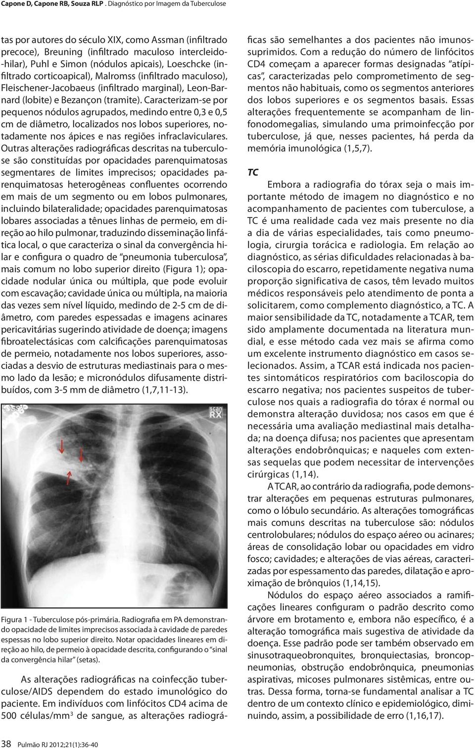 Caracterizam-se por pequenos nódulos agrupados, medindo entre 0,3 e 0,5 cm de diâmetro, localizados nos lobos superiores, notadamente nos ápices e nas regiões infraclaviculares.