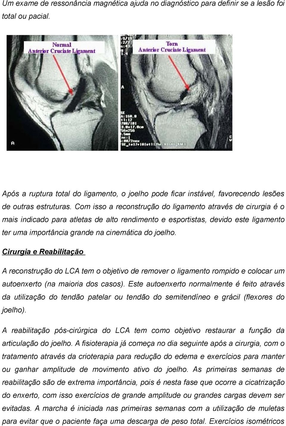 Com isso a reconstrução do ligamento através de cirurgia é o mais indicado para atletas de alto rendimento e esportistas, devido este ligamento ter uma importância grande na cinemática do joelho.