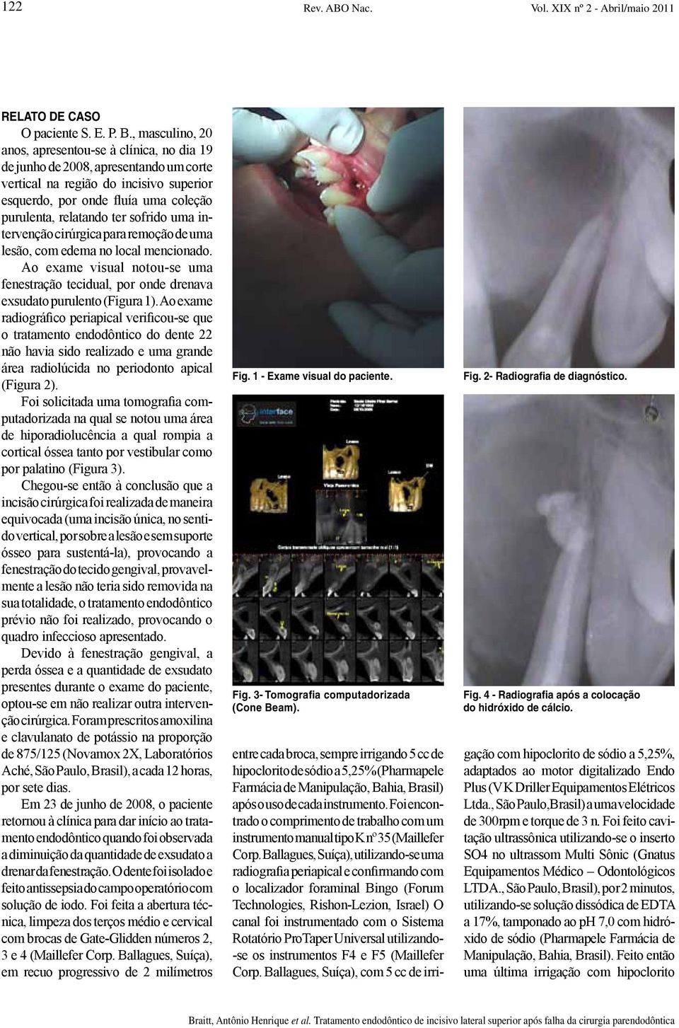 sofrido uma intervenção cirúrgica para remoção de uma lesão, com edema no local mencionado. Ao exame visual notou-se uma fenestração tecidual, por onde drenava exsudato purulento (Figura 1).