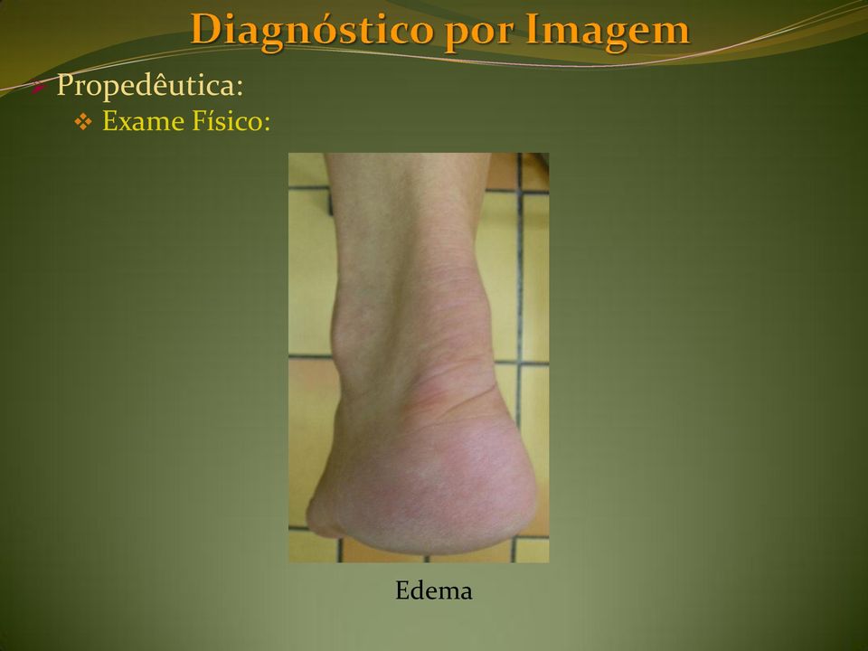 Edema