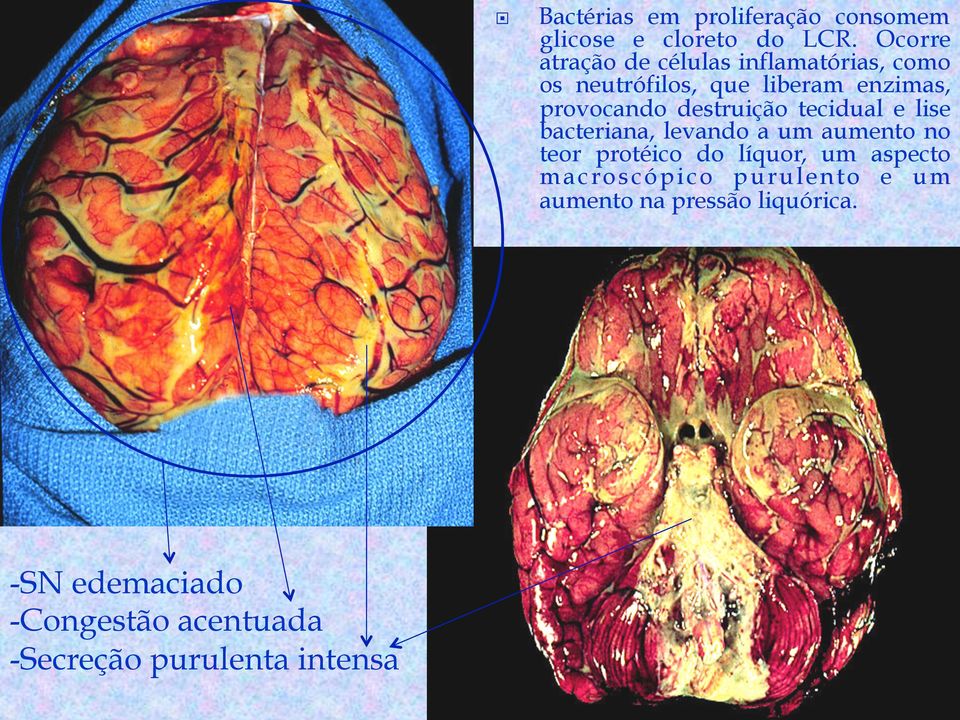 Ocorre atração de células inflamatórias, como os neutrófilos, que liberam enzimas, provocando