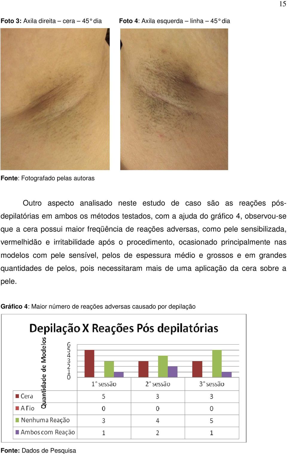 sensibilizada, vermelhidão e irritabilidade após o procedimento, ocasionado principalmente nas modelos com pele sensível, pelos de espessura médio e grossos e em