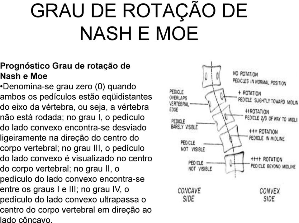 centro do corpo vertebral; no grau III, o pedículo do lado convexo é visualizado no centro do corpo vertebral; no grau II, o pedículo do lado