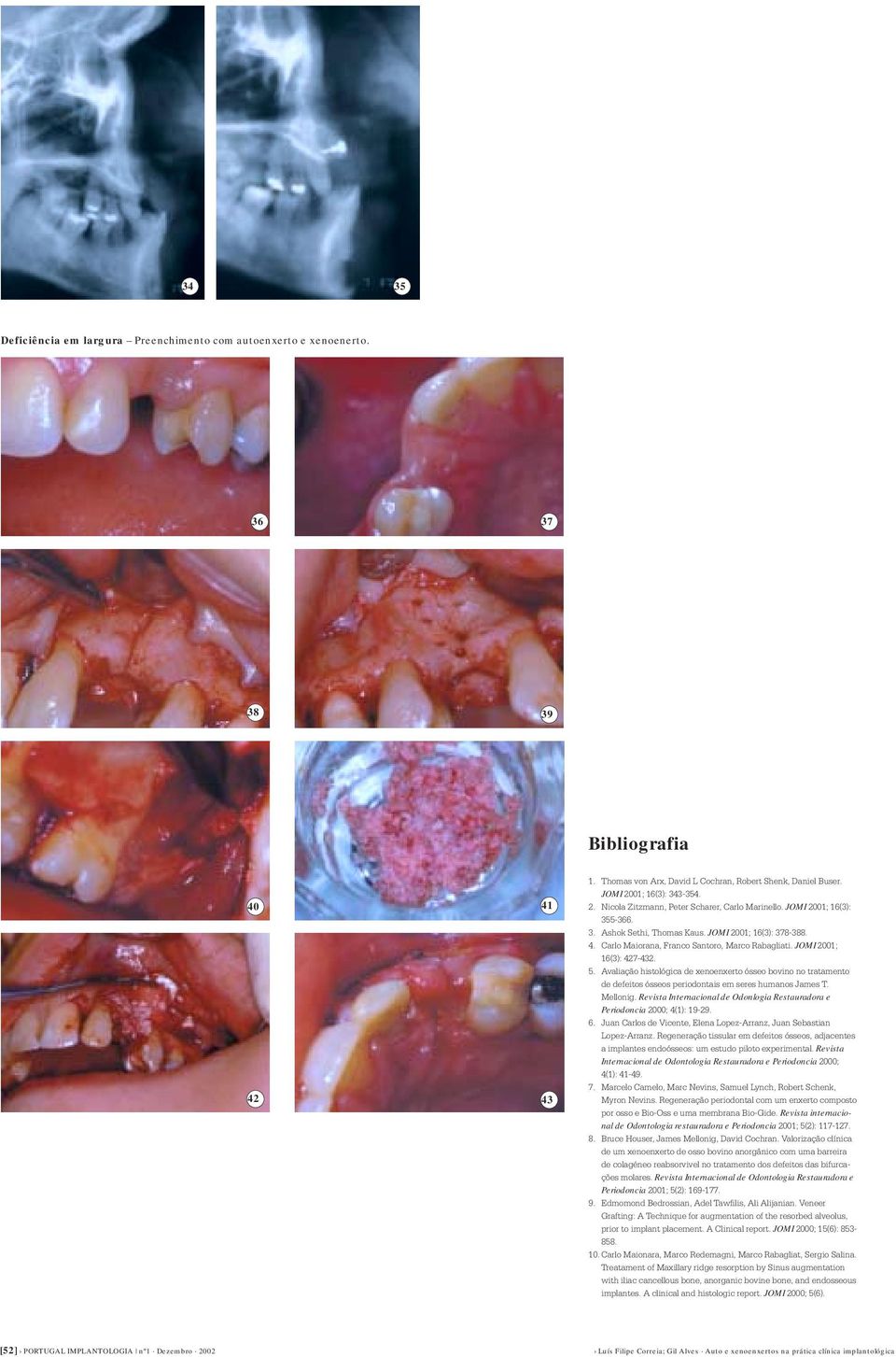 JOMI 2001; 16(3): 427-432. 5. Avaliação histológica de xenoenxerto ósseo bovino no tratamento de defeitos ósseos periodontais em seres humanos James T. Mellonig.