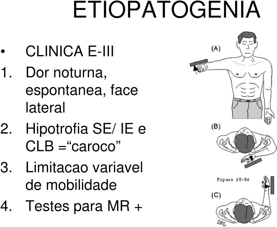 Hipotrofia SE/ IE e CLB = caroco 3.