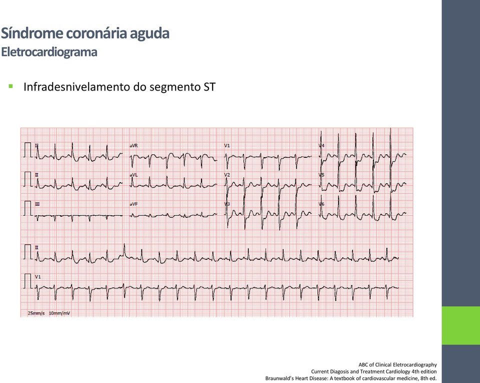 Eletrocardiography Current Diagosis and Treatment