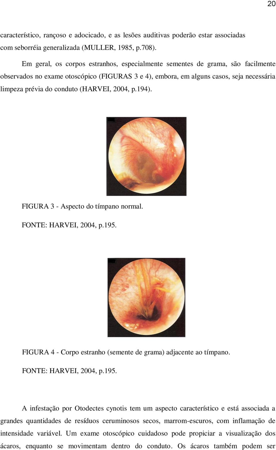 (HARVEI, 2004, p.194). FIGURA 3 - Aspecto do tímpano normal. FONTE: HARVEI, 2004, p.195.