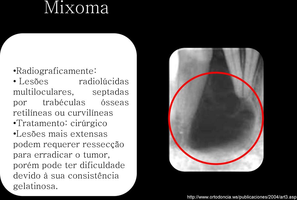 extensas podem requerer ressecção para erradicar o tumor, porém pode ter