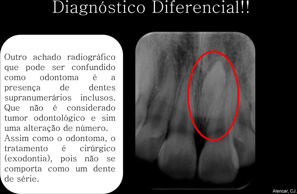 dentes supranumerários inclusos.