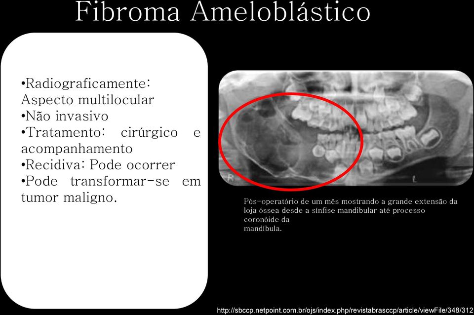 Pós-operatório de um mês mostrando a grande extensão da loja óssea desde a sínfise mandibular