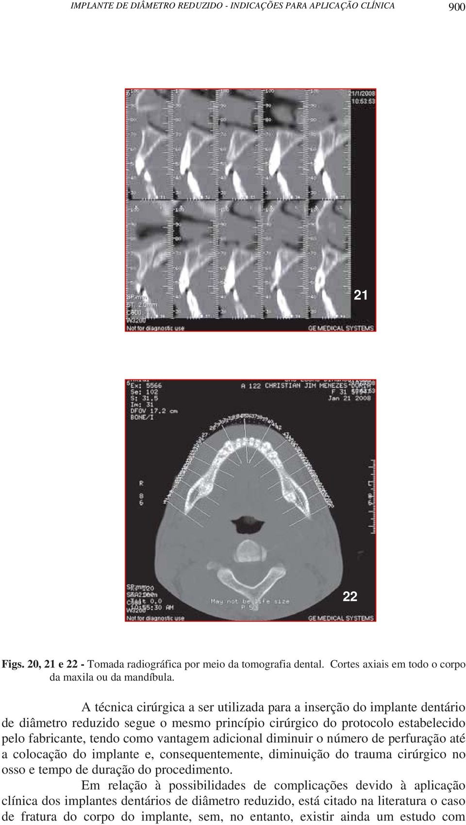 A técnica cirúrgica a ser utilizada para a inserção do implante dentário de diâmetro reduzido segue o mesmo princípio cirúrgico do protocolo estabelecido pelo fabricante, tendo como vantagem