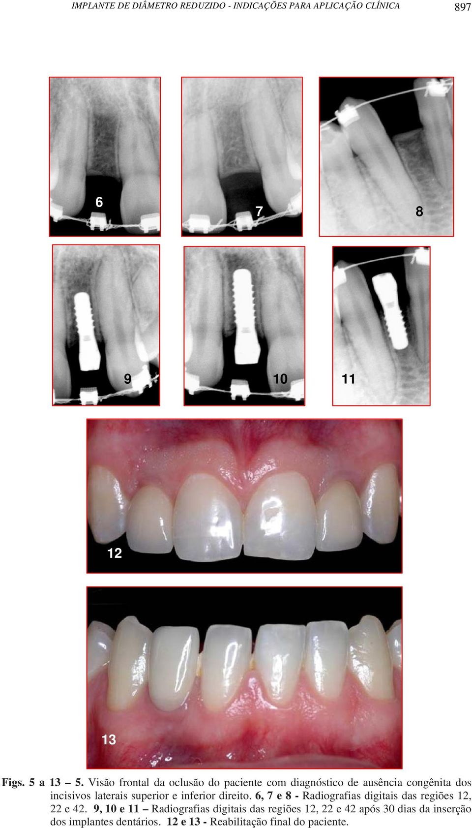 inferior direito. 6, 7 e 8 - Radiografias digitais das regiões 12, 22 e 42.