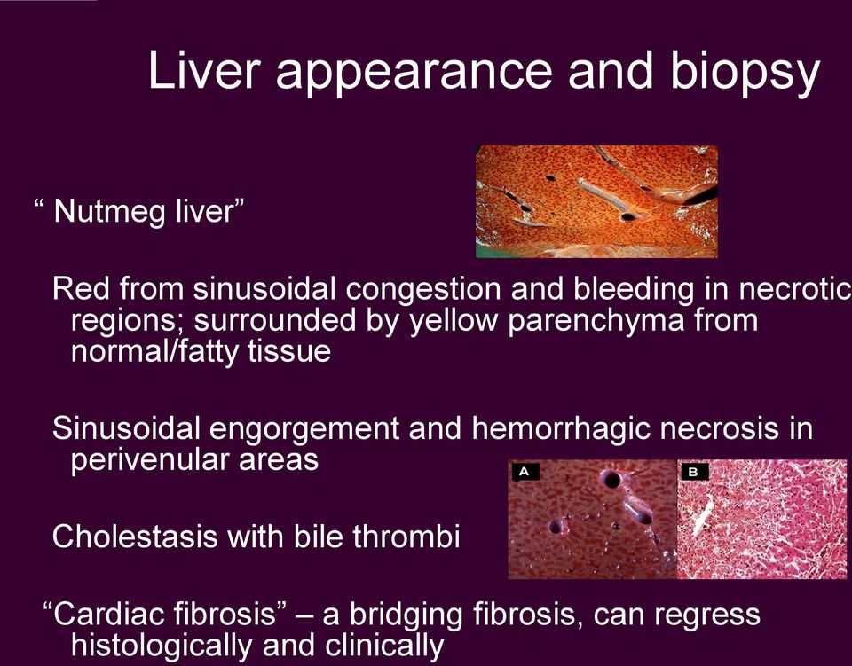 Sinusoidal engorgement and hemorrhagic necrosis in perivenular areas Cholestasis with