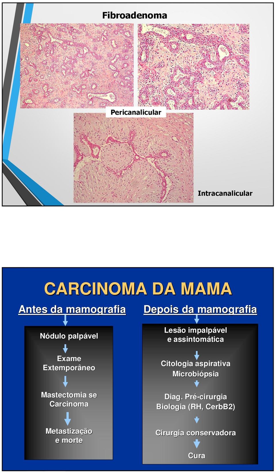 assintomática Citologia aspirativa Microbió Microbiópsia Mastectomia se Carcinoma Diag.