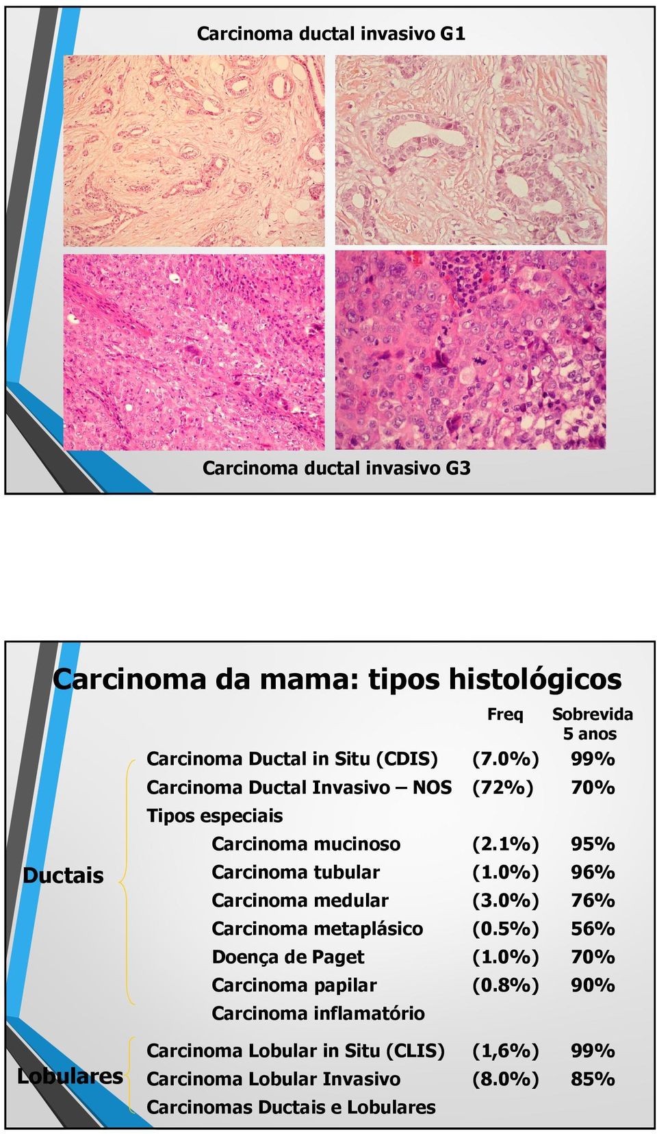 0%) 96% Carcinoma medular (3.0%) 76% Carcinoma metaplásico (0.5%) 56% Doença de Paget (1.0%) 70% Carcinoma papilar (0.