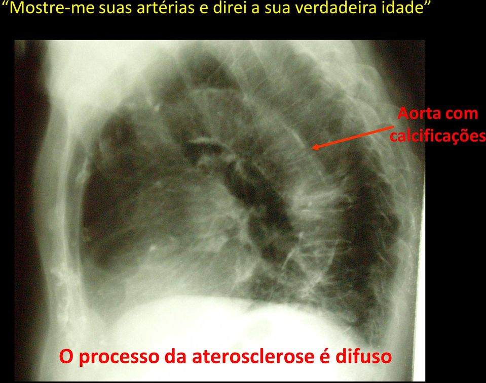 Aorta com calcificações O