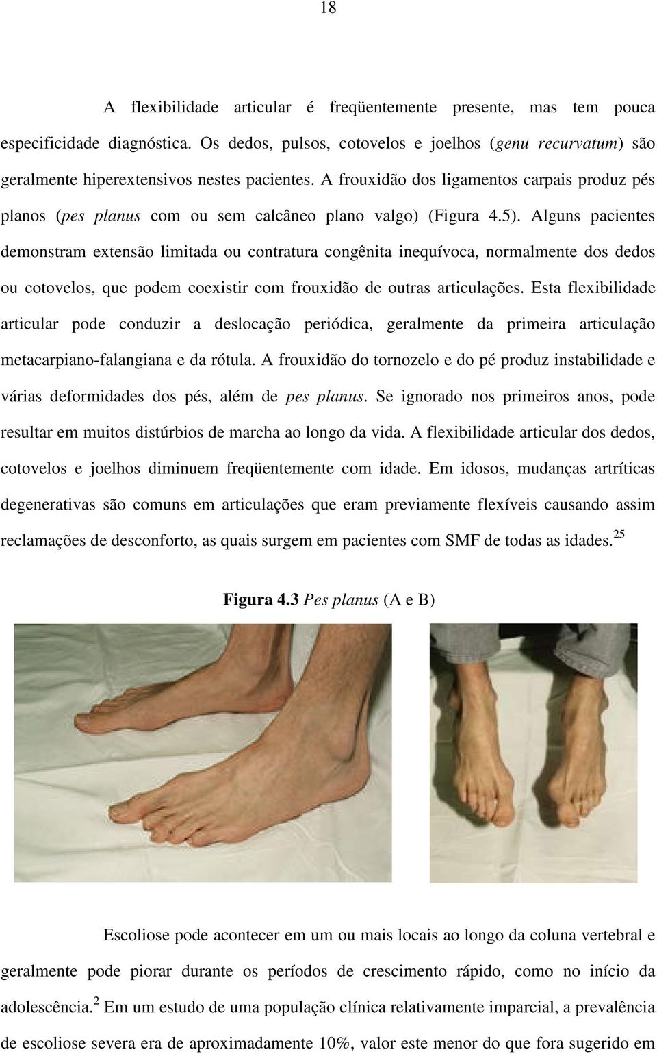 A frouxidão dos ligamentos carpais produz pés planos (pes planus com ou sem calcâneo plano valgo) (Figura 4.5).