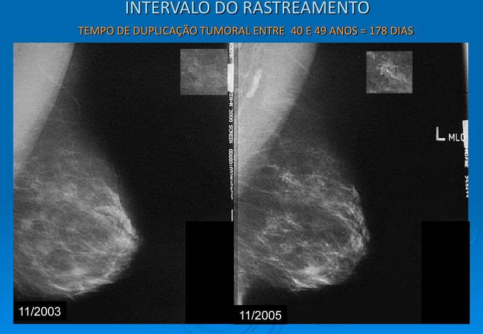 DUPLICAÇÃO TUMORAL ENTRE