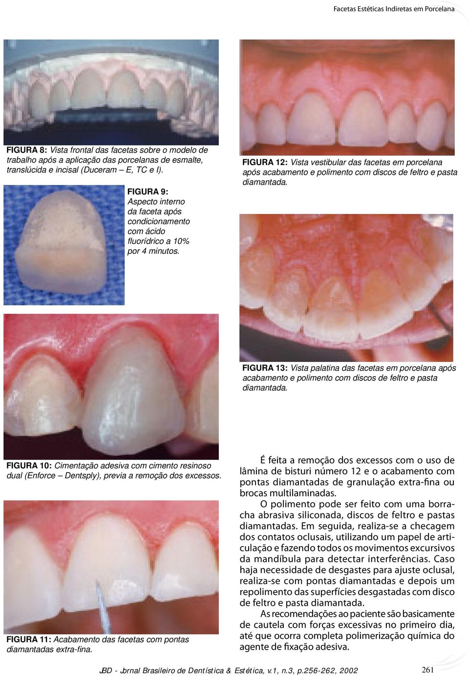 FIGURA 12: Vista vestibular das facetas em porcelana após acabamento e polimento com discos de feltro e pasta diamantada.