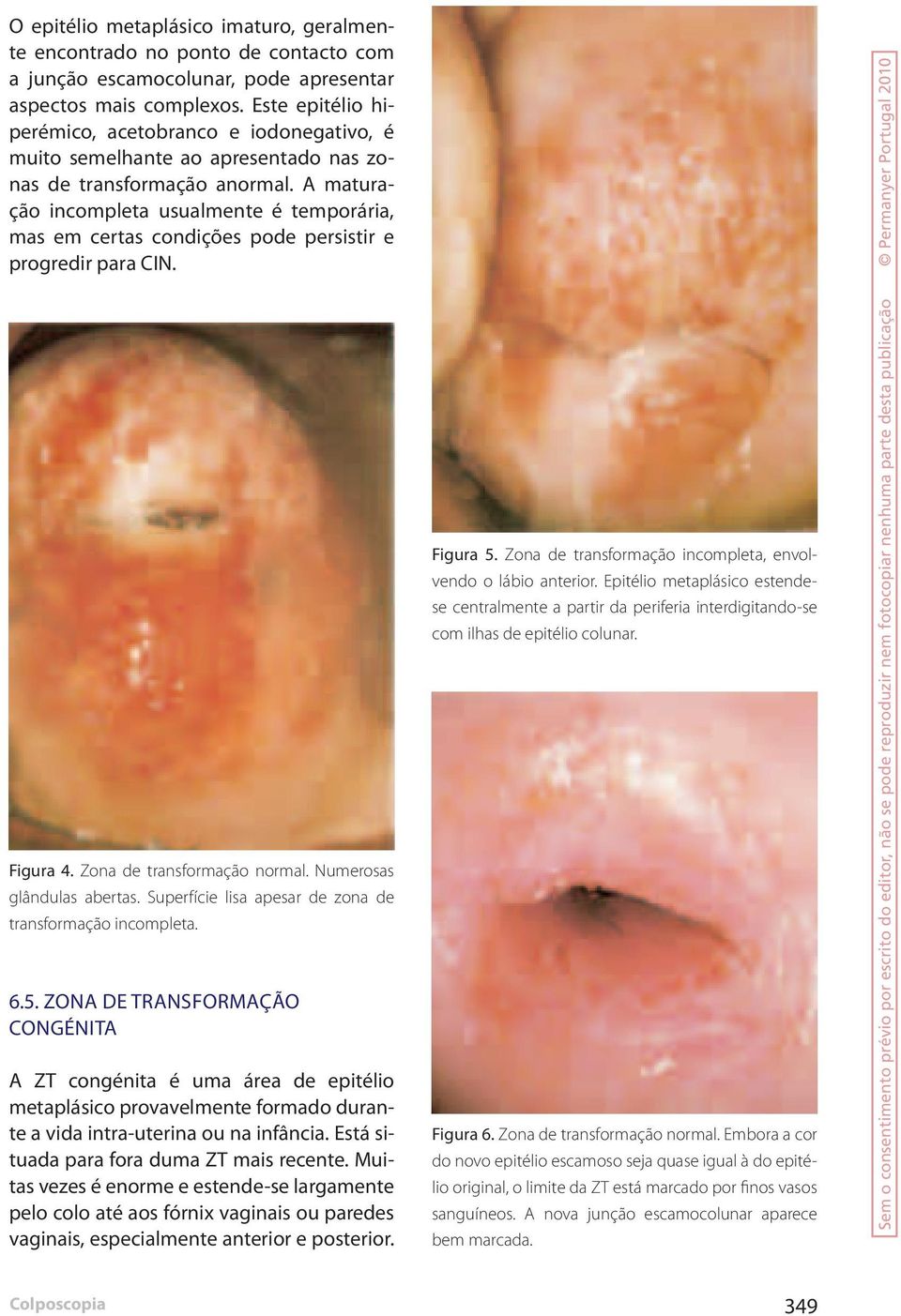 A maturação incompleta usualmente é temporária, mas em certas condições pode persistir e progredir para CIN. Figura 4. Zona de transformação normal. Numerosas glândulas abertas.