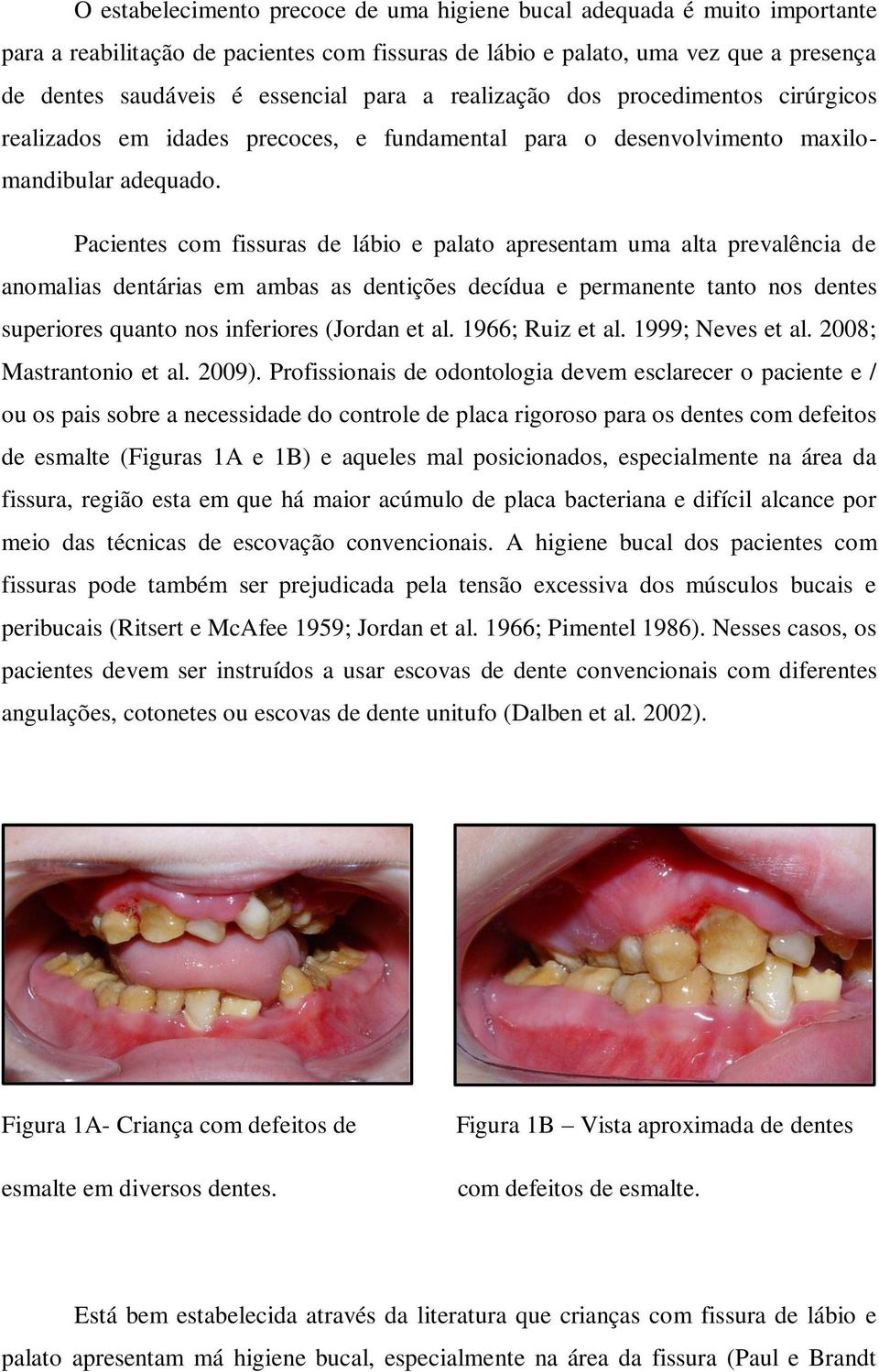Pacientes com fissuras de lábio e palato apresentam uma alta prevalência de anomalias dentárias em ambas as dentições decídua e permanente tanto nos dentes superiores quanto nos inferiores (Jordan et