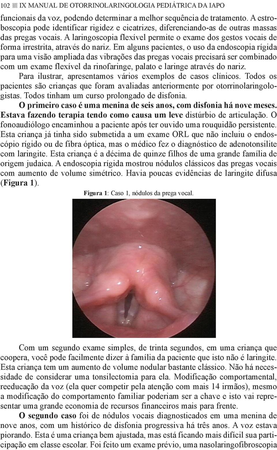 A laringoscopia flexível permite o exame dos gestos vocais de forma irrestrita, através do nariz.