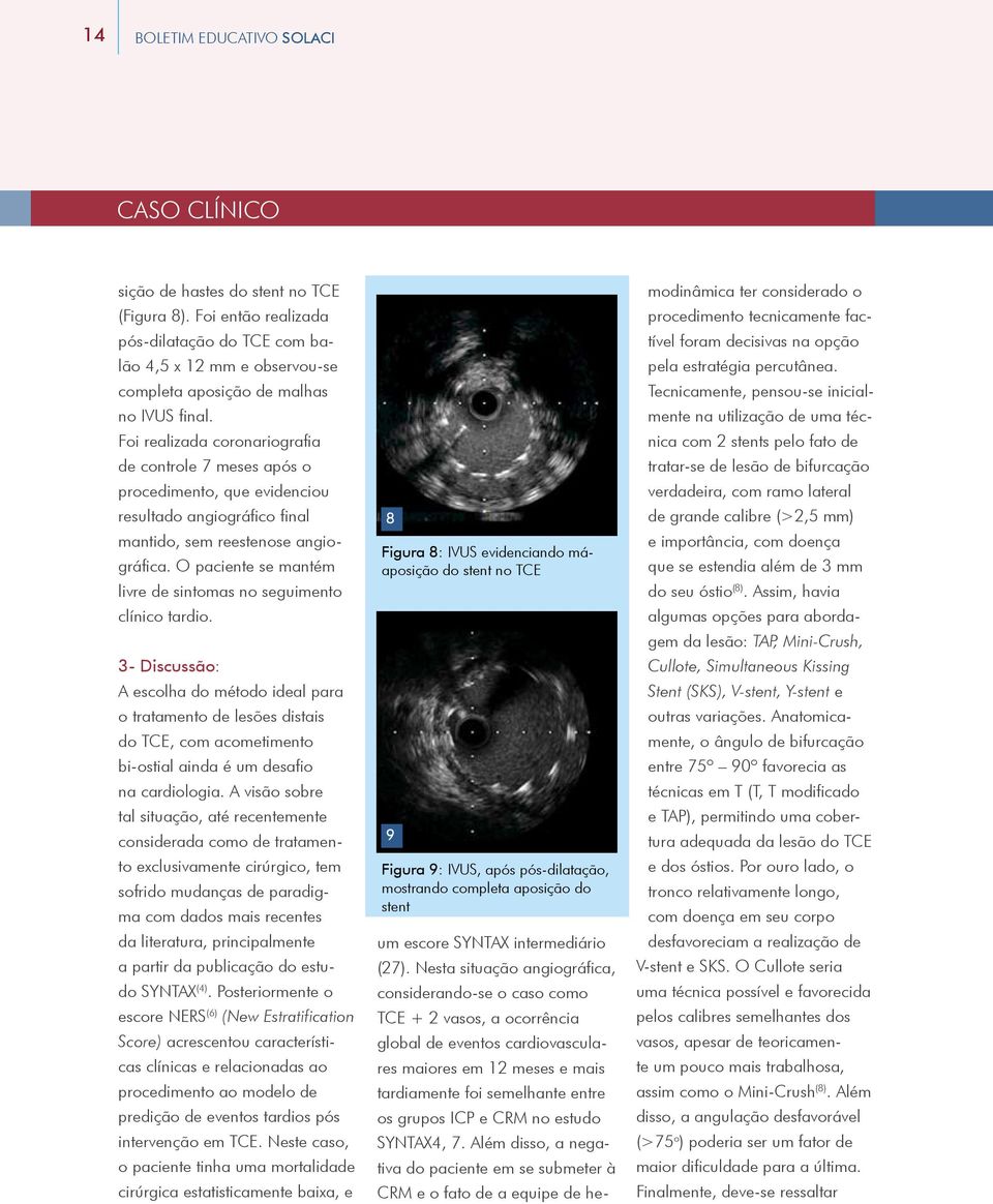 Foi realizada coronariografia de controle 7 meses após o procedimento, que evidenciou resultado angiográfico final mantido, sem reestenose angiográfica.