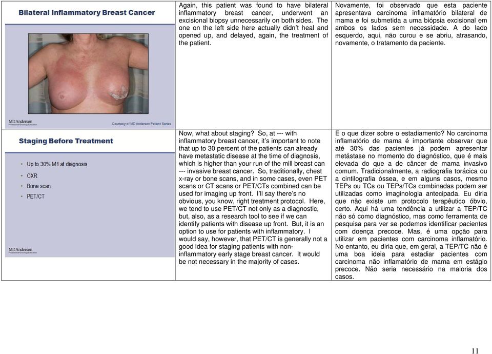 Novamente, foi observado que esta paciente apresentava carcinoma inflamatório bilateral de mama e foi submetida a uma biópsia excisional em ambos os lados sem necessidade.