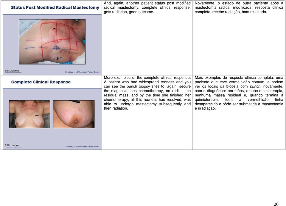 More examples of the complete clinical response: A patient who had widespread redness and you can see the punch biopsy sites to, again, secure the diagnosis, has chemotherapy, no redi --- no residual