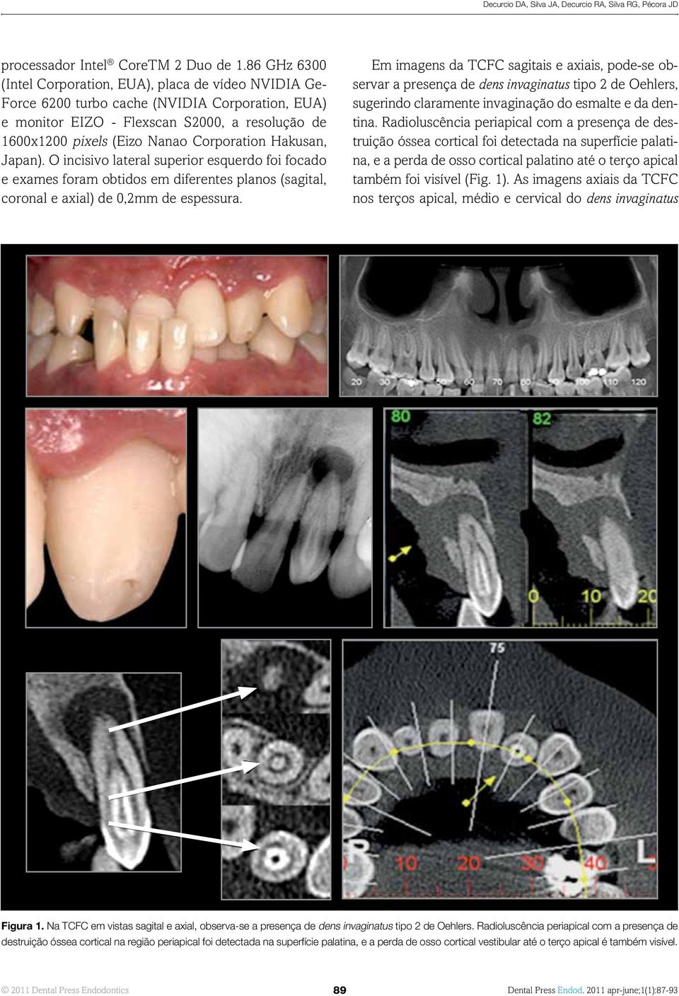 Corporation Hakusan, Japan). O incisivo lateral superior esquerdo foi focado e exames foram obtidos em diferentes planos (sagital, coronal e axial) de 0,2mm de espessura.