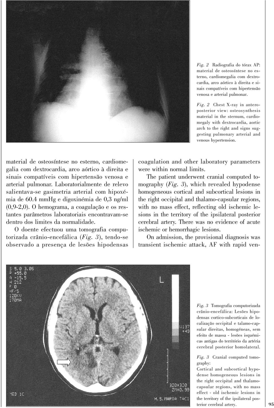 material de osteosíntese no esterno, cardiomegalia com dextrocardia, arco aórtico à direita e sinais compatíveis com hipertensão venosa e arterial pulmonar.